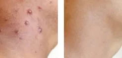 Skin Doctors Ingrow Go gegen eingewachsene Haare